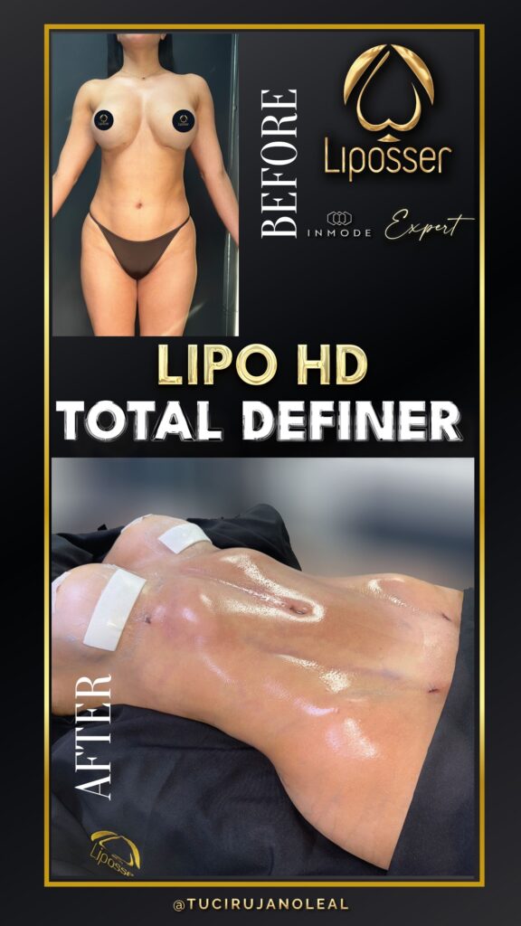 LIipoHD_totaldefiner