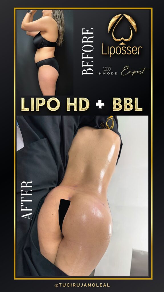 LIipoHD_totaldefiner